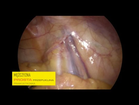 Kilka przykładów różnych wariantów przepuklin pachwinowych w laparoskopii