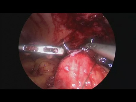 Laparoskopowa operacja przetoki kątniczo-skórnej