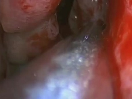 Funkcjonalna endoskopowa operacja zatok - rewizja zatok