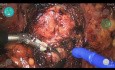 Prostatektomia z wykorzystaniem robota Versius - M. De Dominicis
