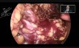 Nefrektomia laparoskopowa