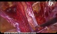 Laparoskopowa operacja nawracającej przepukliny pachwinowej po operacji otwartej