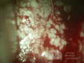 Rak gruczołowy szyjki macicy (Carcinoma Glandulare Colli Uteri)