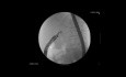 Choledochoduodenostomia pod kontrolą ultrasonografii endoskopowej (EUS)