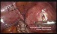 Głęboka endometrioza- salpingektomia, usunięcie torbieli, rectal shaving