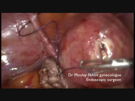 Głęboka endometrioza- salpingektomia, usunięcie torbieli, rectal shaving