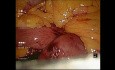 Laparoskopowa resekcja GIST dwunastnicy w trzeciej części dwunastnicy