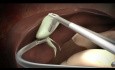 Standaryzacja laparo-endoskopowej jednomiejscowej (LESS) cholecystektomii