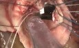 Wymiana zastawki aortalnej - technika operacyjna