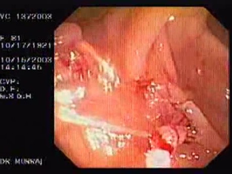 Gruczolak cewkowo - kosmkowy - endoskopia (7 z 28)