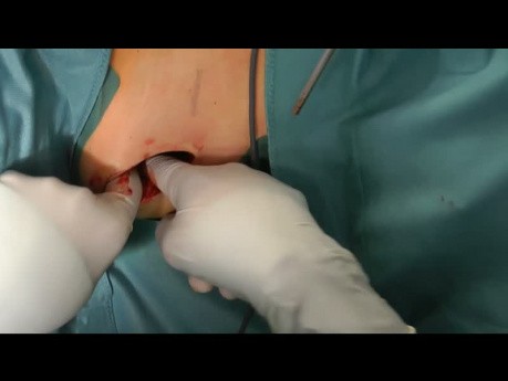 Implantacja pompy baklofenowej
