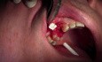 Ekstrakcja zęba 1-5 z jednoczesnym przeszczepem kostnym - d-PTFE - aplikacja błony zaporowej