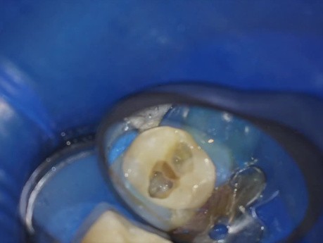 1-minutowe kliniczne wskazówki dotyczące blokady kanału