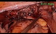 Laparoskopowa histerektomia i sakrokolpopeksja u starszej pacjentki cierpiącej na wypadanie macicy