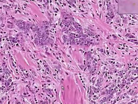 Prostata - Gruczolakorak (Gleason klasy 5) - Badanie histopatologiczne