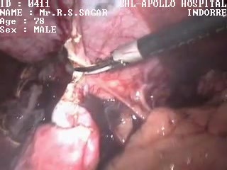 Torbiel wątroby - operacja laparoskopowa