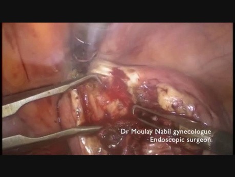 Polimiomektomia laparoskopowa z pojedynczym nacięciem