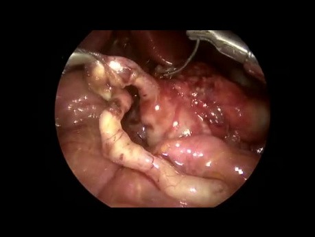 Laparoskopowa operacja Ladda u noworodka z malrotacją jelit