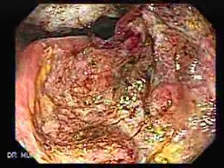 Rak gruczołowy jamy odźwiernikowej (1 z 5)