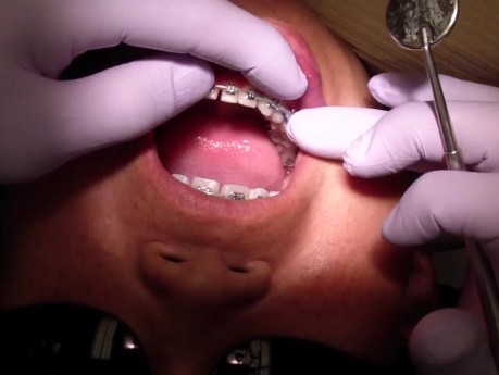 Przypadek Ortodontyczny #2 - Przegląd leczenia po 6 miesiącach terapii - Stały Aparat