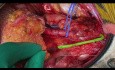 Zespolenie "koniec do końca" tętnicy nabrzusznej dolnej z tętnicą biegunową dolną