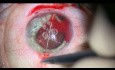 Usunięcie soczewki oraz plastyka tęczówki w oku pourazowym