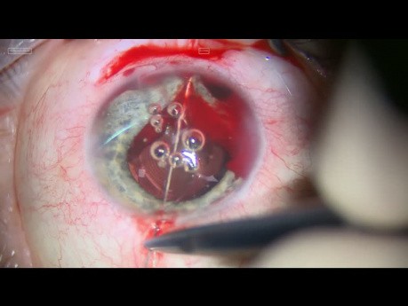 Usunięcie soczewki oraz plastyka tęczówki w oku pourazowym
