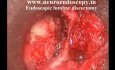 Endoskopowa discektomia lędźwiowa