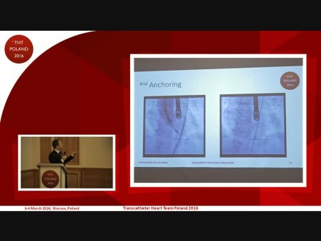 The Road Not Taken – TAVI in biscupid aortic valves using second-generation systems