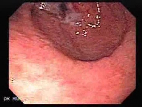 Rak gruczołowy jamy przedodźwiernikowej (1 z 3)