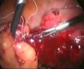 Leczenie laparoskopowe urazu jelita (powikłanie wkładki wewnątrzmacicznej)