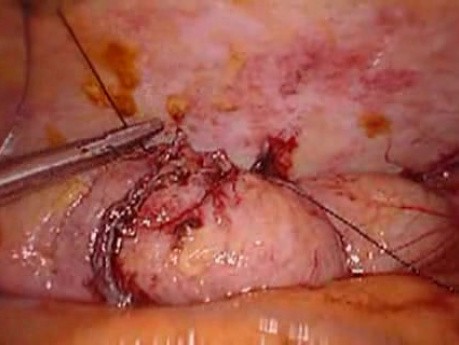 Perforacja okrężnicy z zapaleniem otrzewnej - laparoskopia (10 z 46)