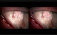 Torbiel skórzasta kąta przyśrodkowego- krwotok śródoperacyjny