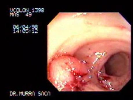 Uszypułowany polip wewnątrz ujścia wyrostka robaczkowego (2 z 2)