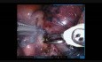 Resekcja dolnego płata płuca prawego w asyście robota chirurgicznego 