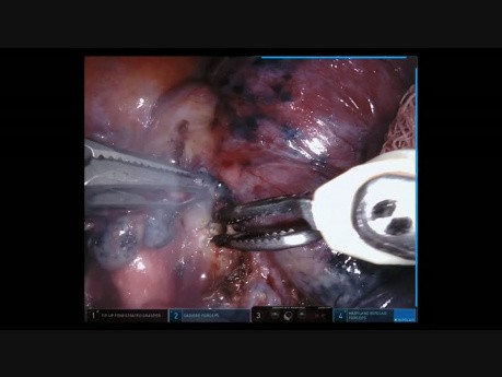 Resekcja dolnego płata płuca prawego w asyście robota chirurgicznego 