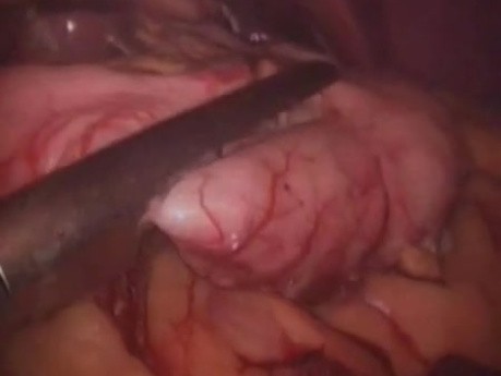Rękawowe wycięcie żołądka - laparoskopia