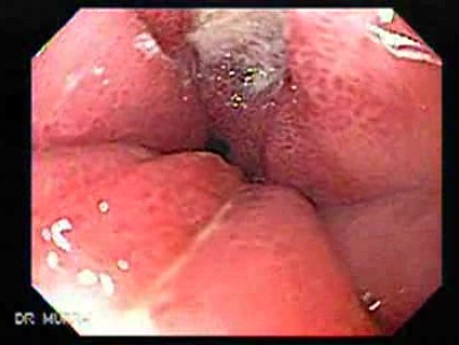 Żołądek klepsydrowaty - bliższe spojrzenie na regenerujący się nabłonek, część 1