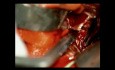 Malformacja tętniczo-żylna AVM