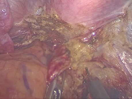 Endometrioza głęboka – 6-minutowy przypadek chirurgiczny