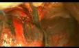 Bilobektomia metodą otwartą z powodu niedrobnokomórkowego raka płuca