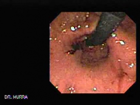 Żołądek - endoskopia - sekwencja wideo (3 z 6)