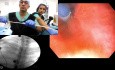 Esophageal SEMS Placement - Tips and Tricks