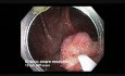 Kolonoskopia: resekcja en-bloc siedzącego ząbkowanego gruczolaka