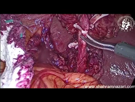 Cholecystektomia laparoskopowa krok po kroku
