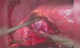 TachoSil® w przypadku cholecystektomii laparoskopowej z powodu ostrego zapalenia pęcherzyka żółciowego
