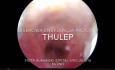 Laserowa enukleacja prostaty laserem Tulowym ThuLEP