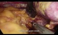 Całkowita resekcja żołądka z limfadenektomią D2 metodą laparoskopową