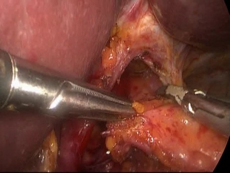 Laparoskopowa kardiomiotomia metodą Hellera-Achalazja z przepukliną rozworu przełykowego