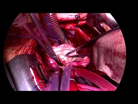 Implantacja Bezszwowej Zastawki Aortalnej - Perceval S